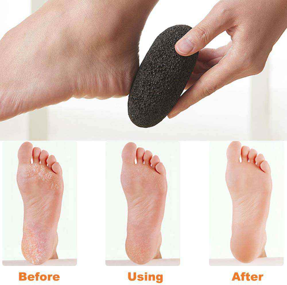 Pumice stone used on the heel, with before and after results